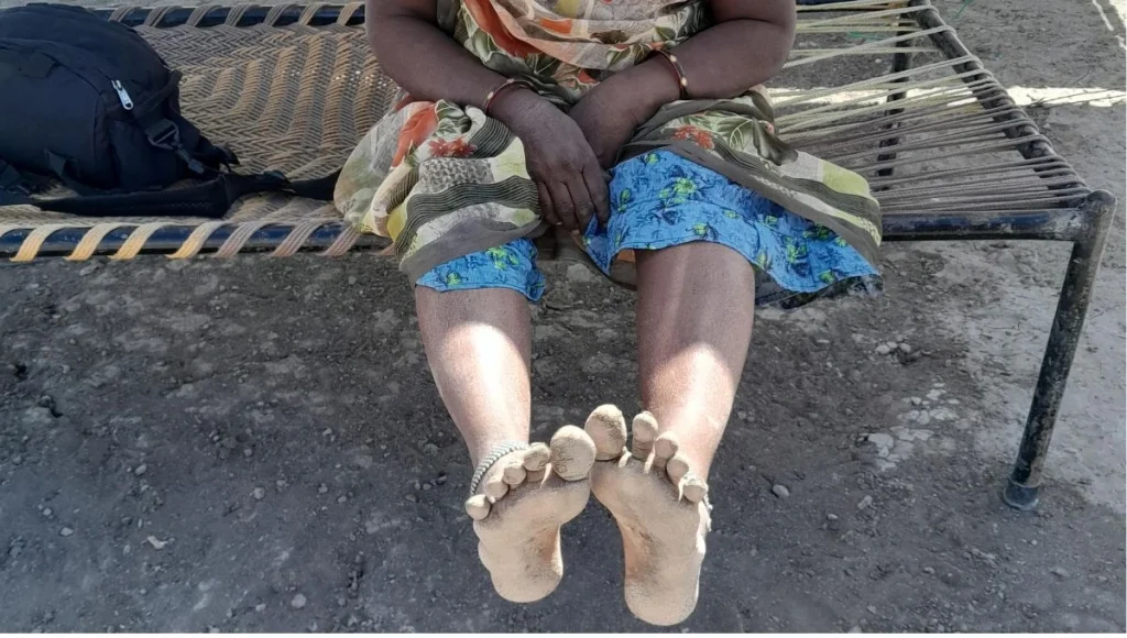 a woman's legs, extended, with the focus being on her feet, which have corns--salt farming
